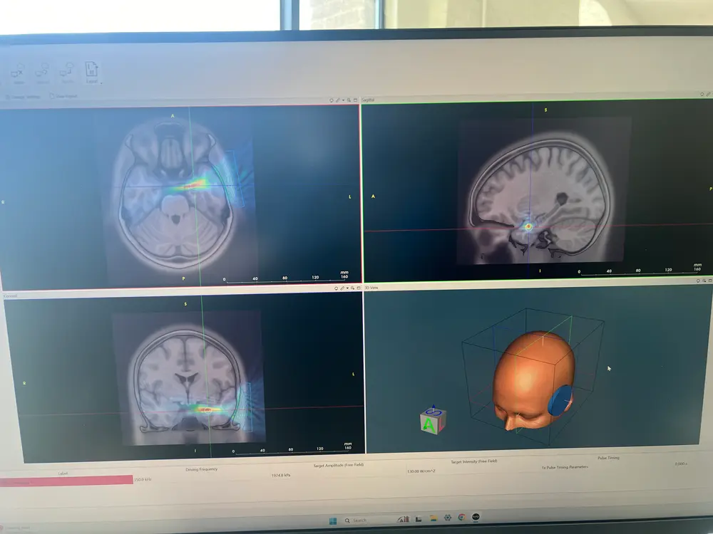 Transcranial focused ultrasound planning software with MRI targeting views